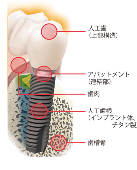 インプラント治療って何？